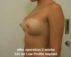 plastic-surgery-breast-augmentation